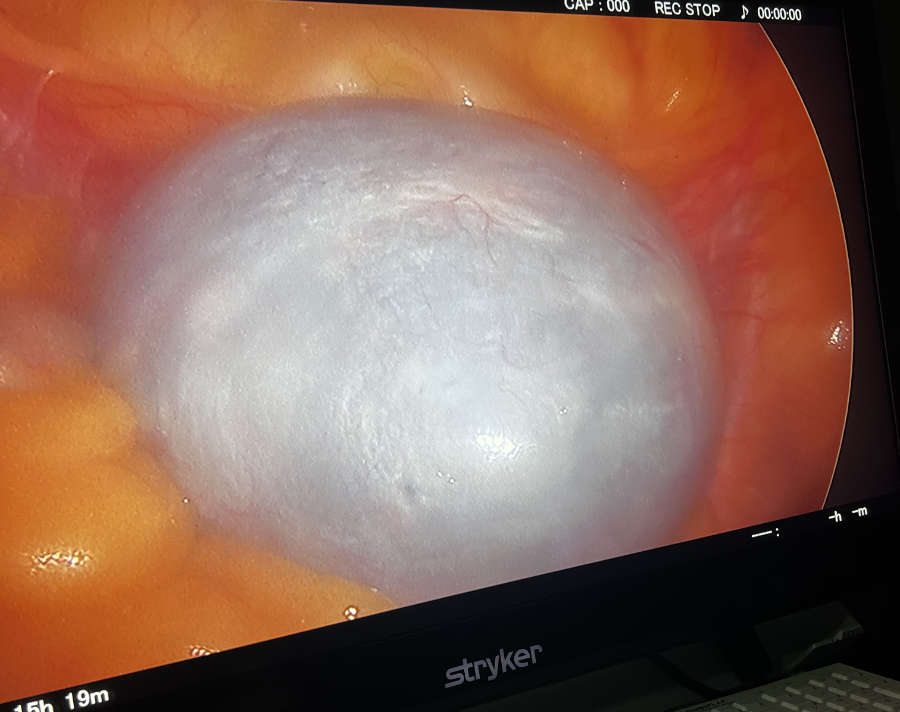OVARIAN CYST SURGERY IN GURGAON BY DR ASTHA DAYAL