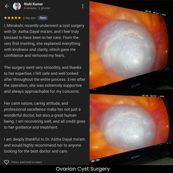 ovarian cyst surgery in gurgaon